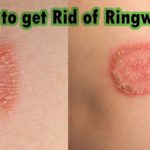 Defeating Ringworm