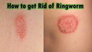 Defeating Ringworm